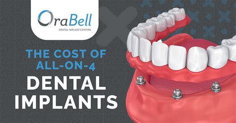 cheapest all on four dental implants cost